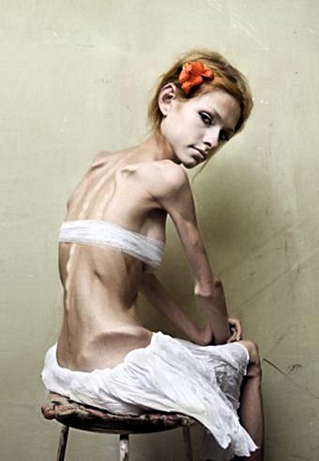 Anorexia-victim